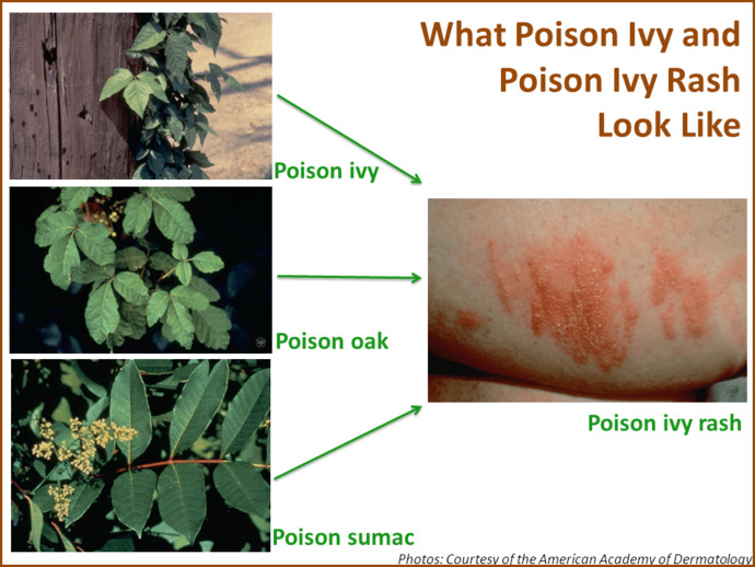 Ever have a tough encounter with a poisonous plant?