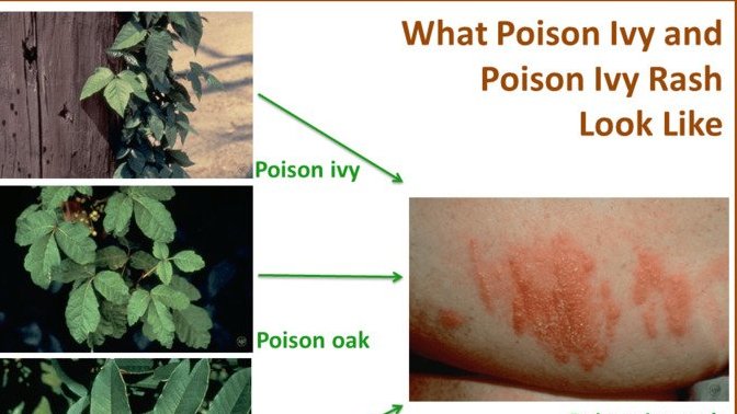 Ever have a tough encounter with a poisonous plant?