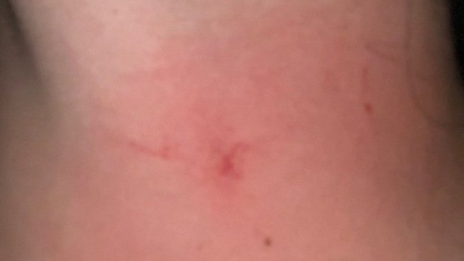 Guys, Is this a hickey? I’m talking with my ex again and he has a red mark on his neck and I can’t tell if it’s a hickey. If it is it’s not from me…?