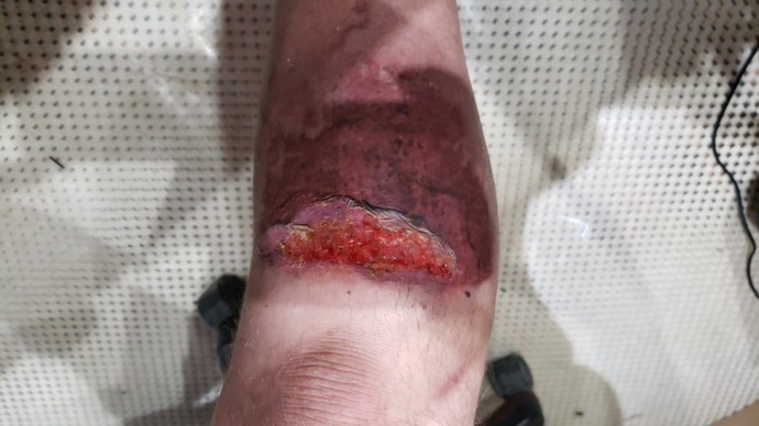 How painful would burning at the stake be?