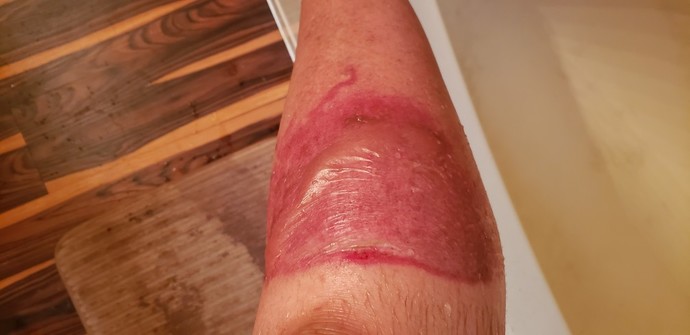 How painful would burning at the stake be?
