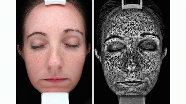 sun damage shown under ultraviolet lighting