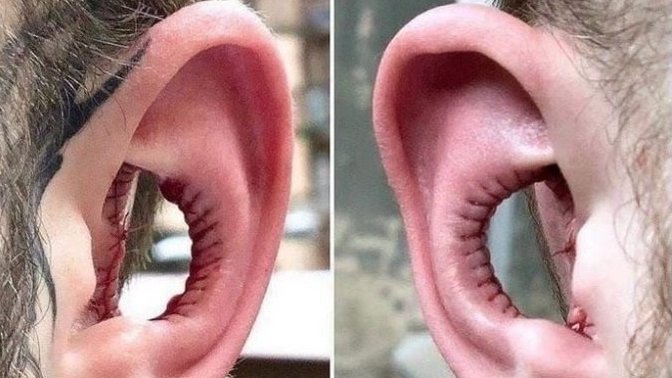 Would you be open to modifying your ears by undergoing a trendy "Conch Removal"?