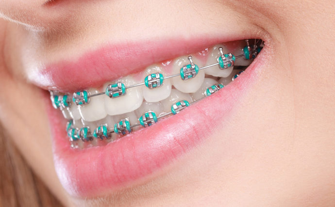 Have you ever worn braces, and if so how long did you have them for?