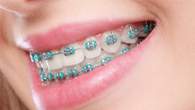 Have you ever worn braces, and if so how long did you have them for?
