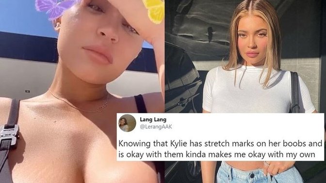 Are Stretch Marks On B👀bs Considered Unattractive?