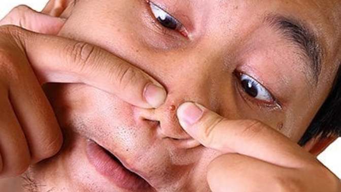 What is more annoying? Blackheads or whiteheads?