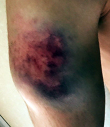 Shoulder dislocated. I still won.