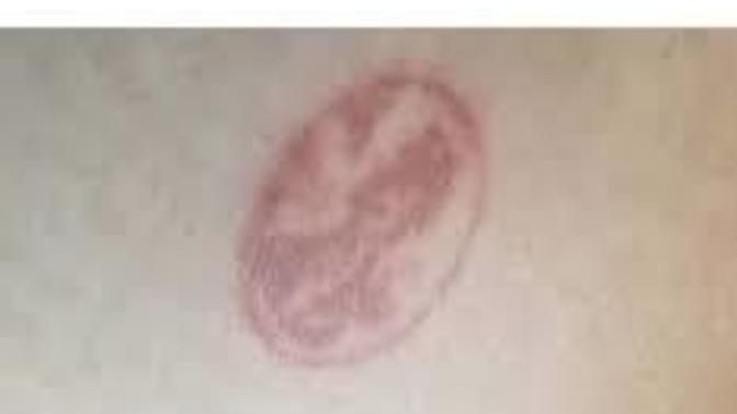 Have you ever been branded accidentally or on purpose by ink hot metal or other?