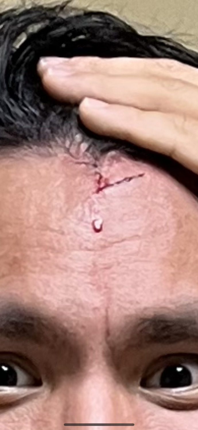 Fight aftermath: How bad or cool is this scar?