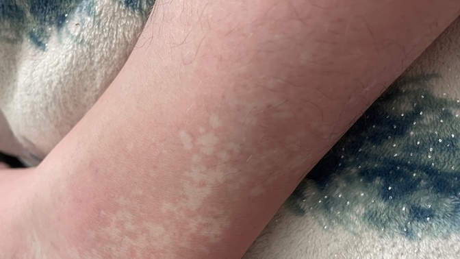 Dose any one know what these white spots on my ankle are called or what might cause the spots?