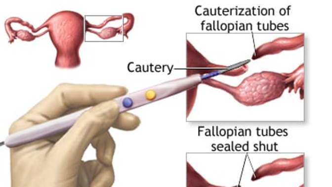 Should US women without children more easily be able to sterilize themselves as US men are able to?