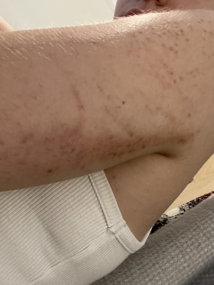 What is this rash? Meningitis?