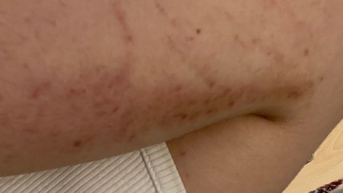 What is this rash? Meningitis?