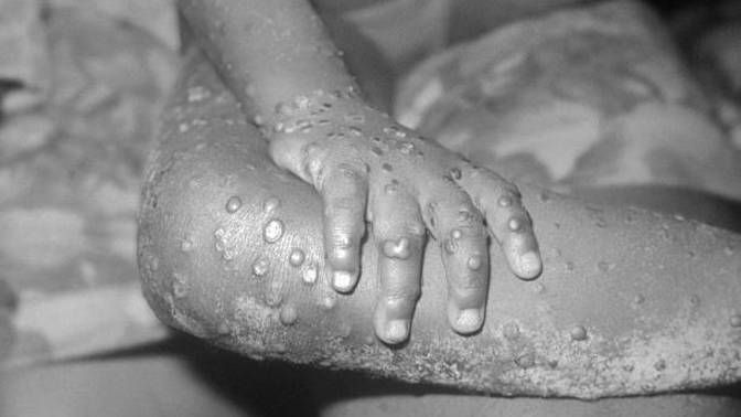Are you afraid of monkey pox?