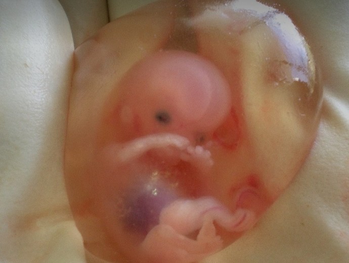 Do you understand what happens in an abortion?