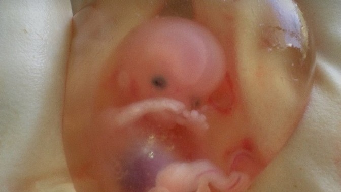 Do you understand what happens in an abortion?