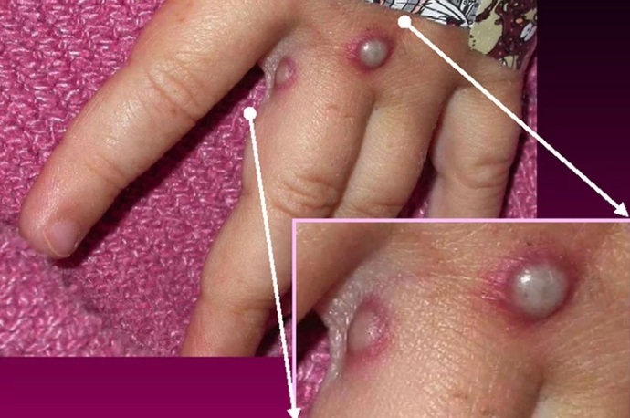 Symptoms of Monkeypox shown on a patients hand. In most cases, the disease causes fever & painful pus-filled blisters
