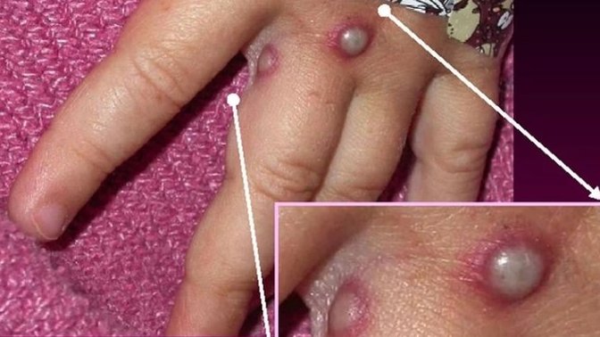 Are you worried about Monkeypox?