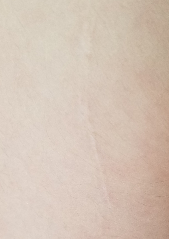 How did you get your scar or scars?