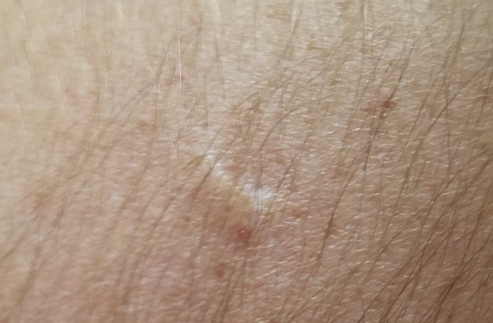 How did you get your scar or scars?