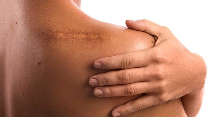 How did you get your scar or scars?