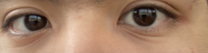 Does the lines like this under the eye requires treatment? If yes, what treatment should it get? Is this an aging issue?