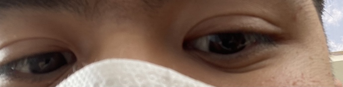 Does the lines like this under the eye requires treatment? If yes, what treatment should it get? Is this an aging issue?
