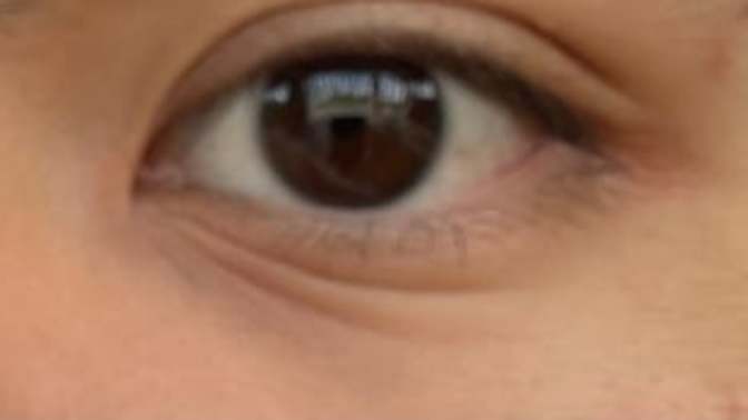 Does the lines like this under the eye requires treatment? If yes, what treatment should it get? Is this an aging issue?