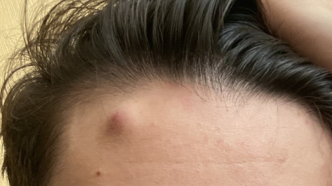 How do I get rid of this big acne on my forhead?