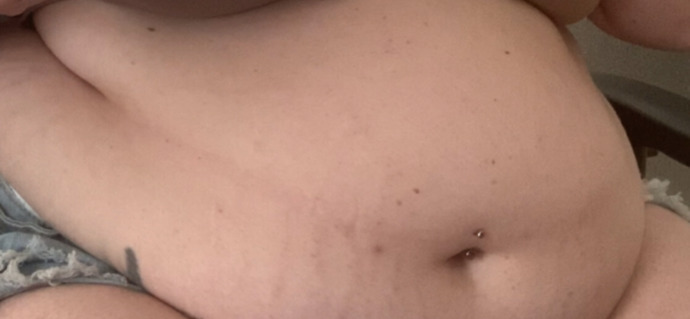 Why do I have more freckles on my tummy now that I gained weight?