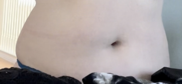 Why do I have more freckles on my tummy now that I gained weight?