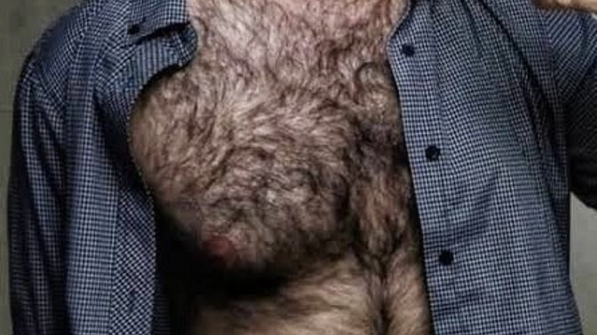 Excessive male body hair, what's the best solution?