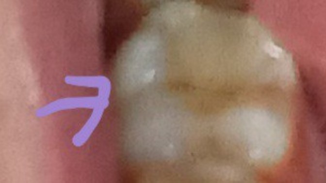 Is this stain on my filling or cavity?