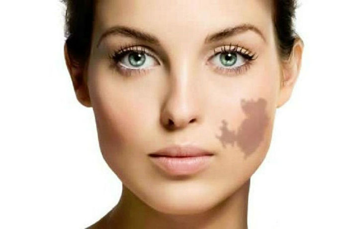 What do you think of birthmarks? Do you have a birthmark?