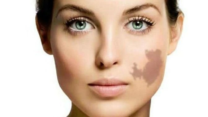 What do you think of birthmarks? Do you have a birthmark?