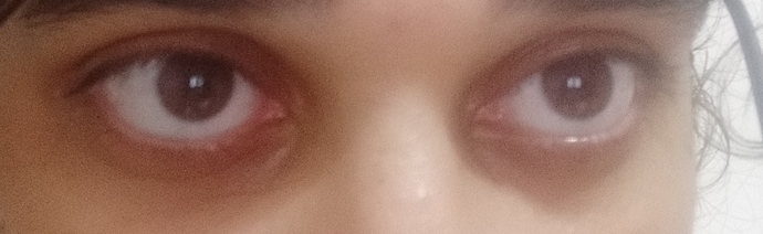 Would you date someone with dark circles?