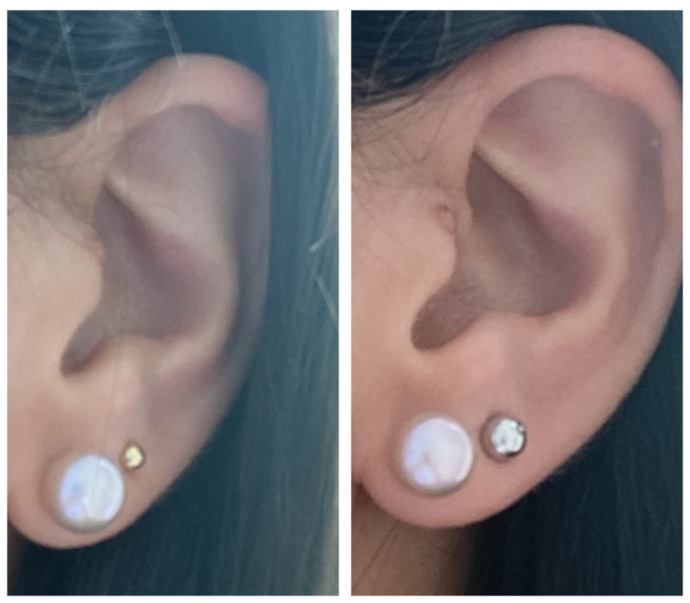 Which second stud size looks best 3mm (left) or 5mm (right) ?