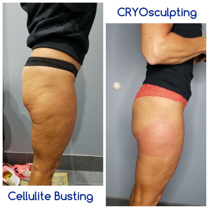 Guys: Is cellulite a turn off for you?