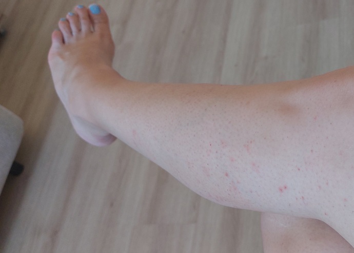 Spots on my leg?