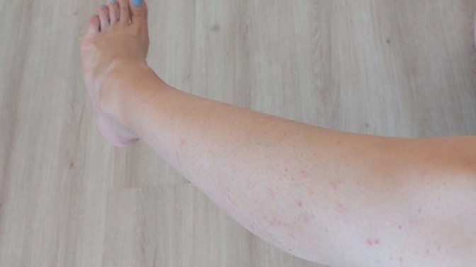 Spots on my leg?