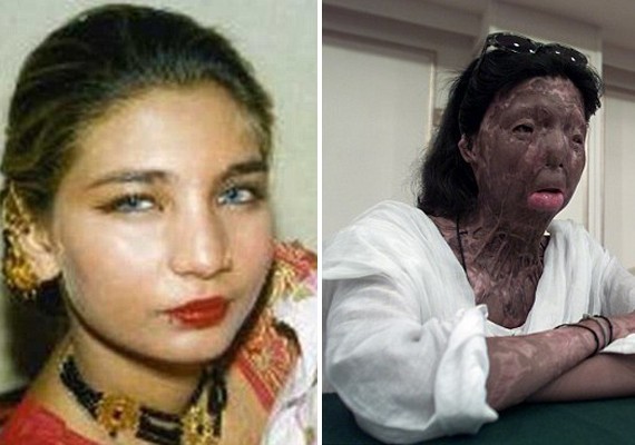 Would you leave your boyfriend/girlfriend if they ever got attacked in an acid attack?