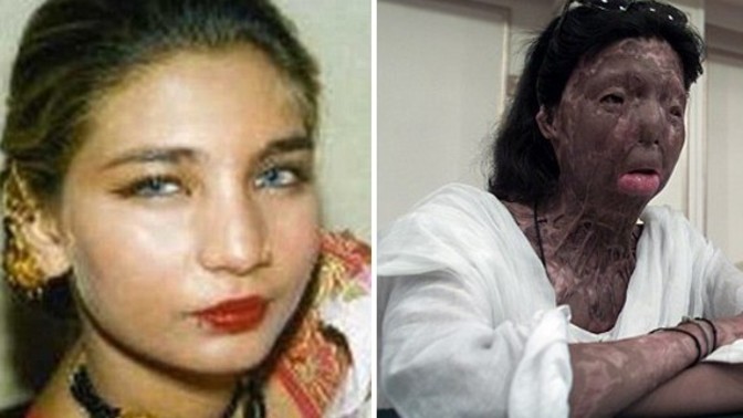Would you leave your boyfriend/girlfriend if they ever got attacked in an acid attack?