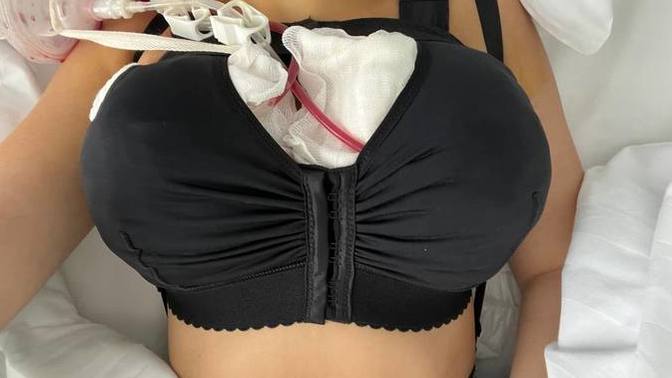 I'm 24, and I had breast augmentation surgery. Is that normal? ?