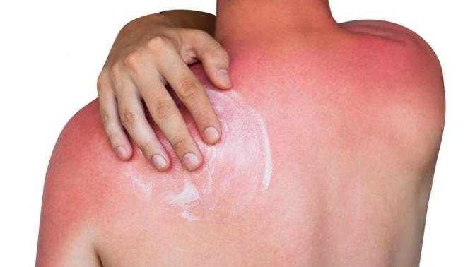 What's the best remedy for sunburn?