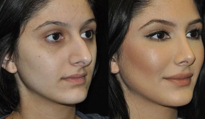 Men, what are your opinions on women who get nose jobs?