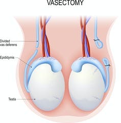 Should Pro choice/Abortion men get vasectomies in support?