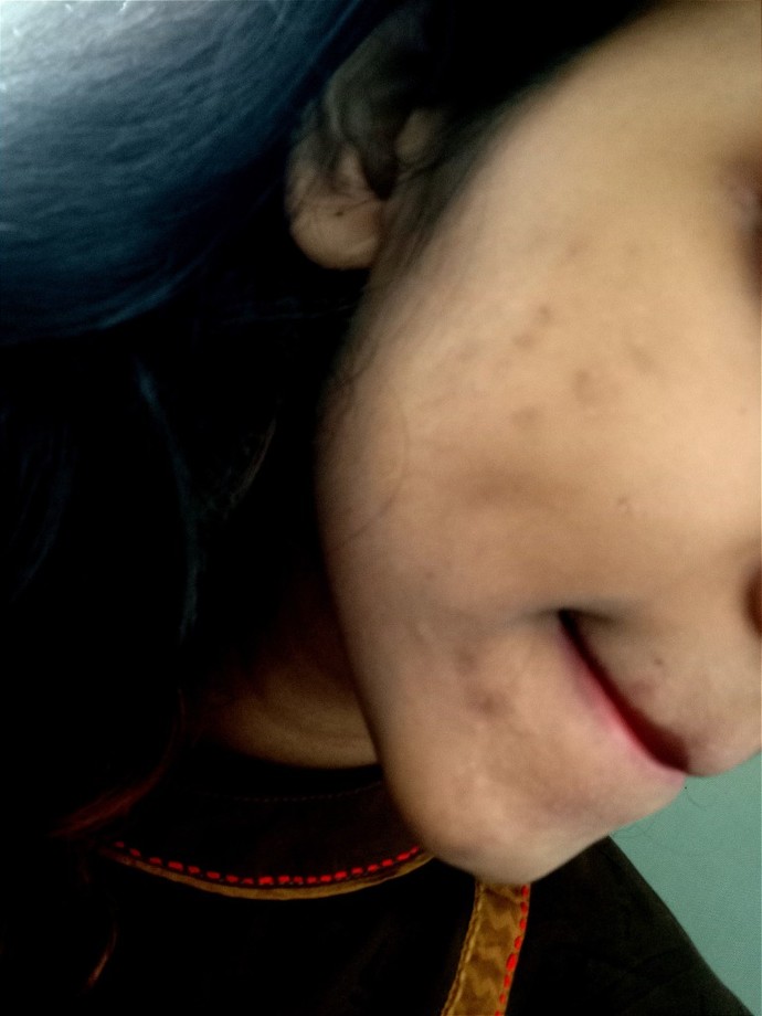 How to get rid of these dark spots?