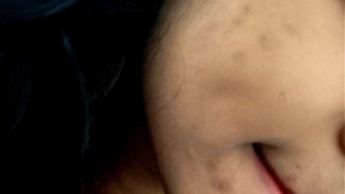 How to get rid of these dark spots?