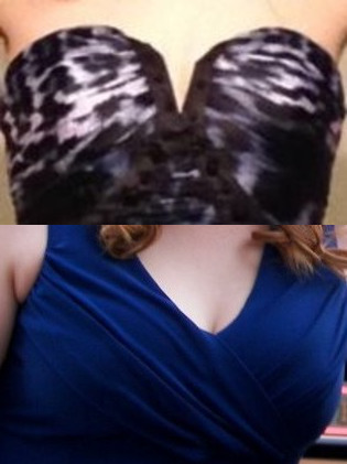 Why did my breasts shrink from D cups to A cups with weight loss?